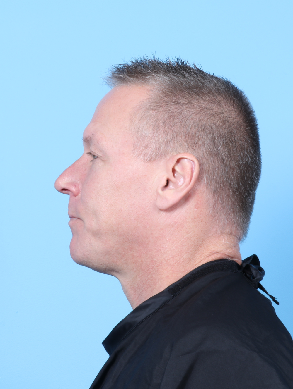 Eyelid Surgery Patient Photo - Case 7783 - before view-2