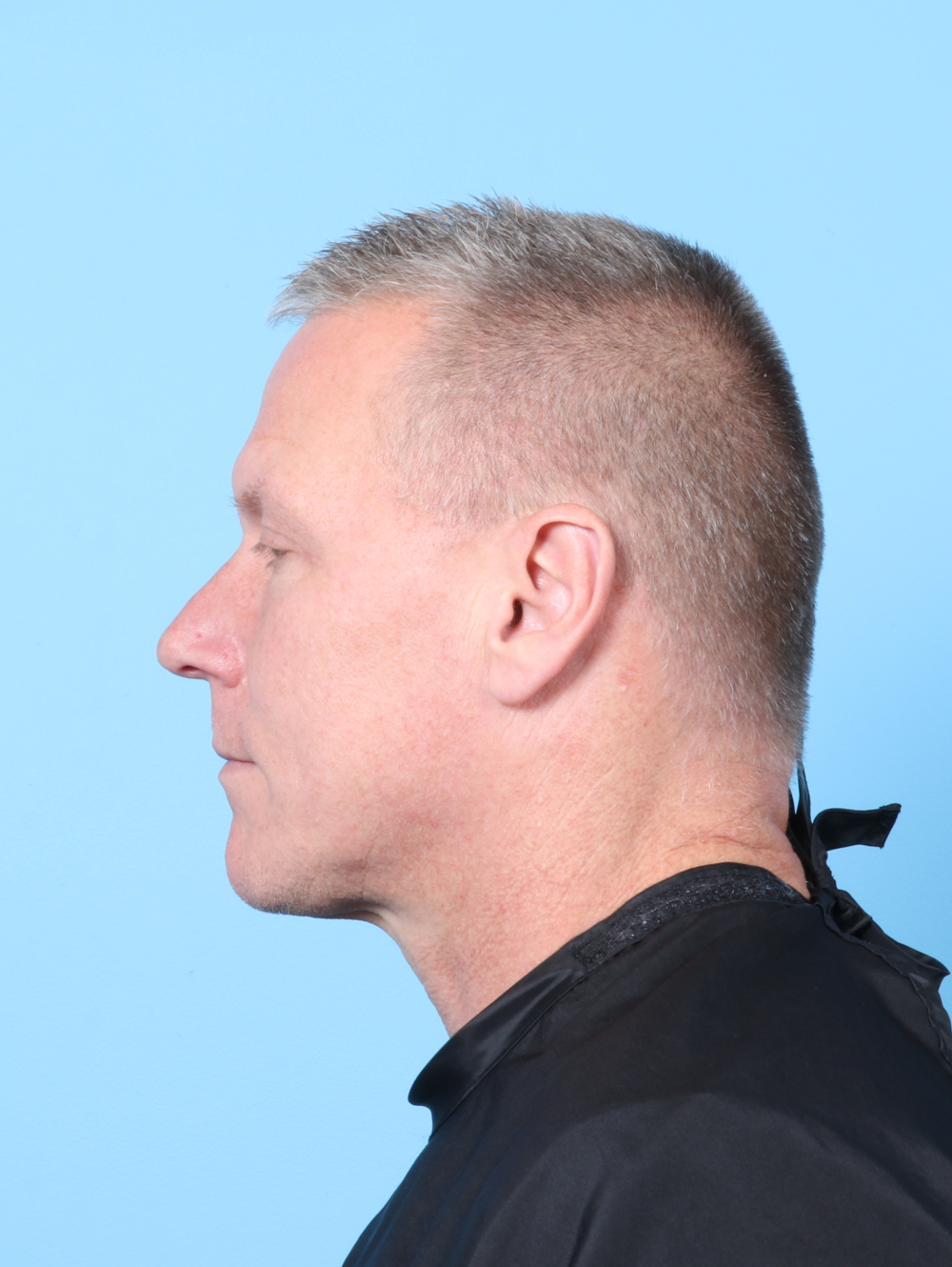 Eyelid Surgery Patient Photo - Case 7783 - after view-2