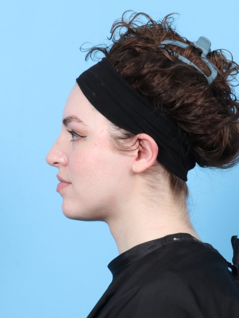 Rhinoplasty - Case 7839 - After