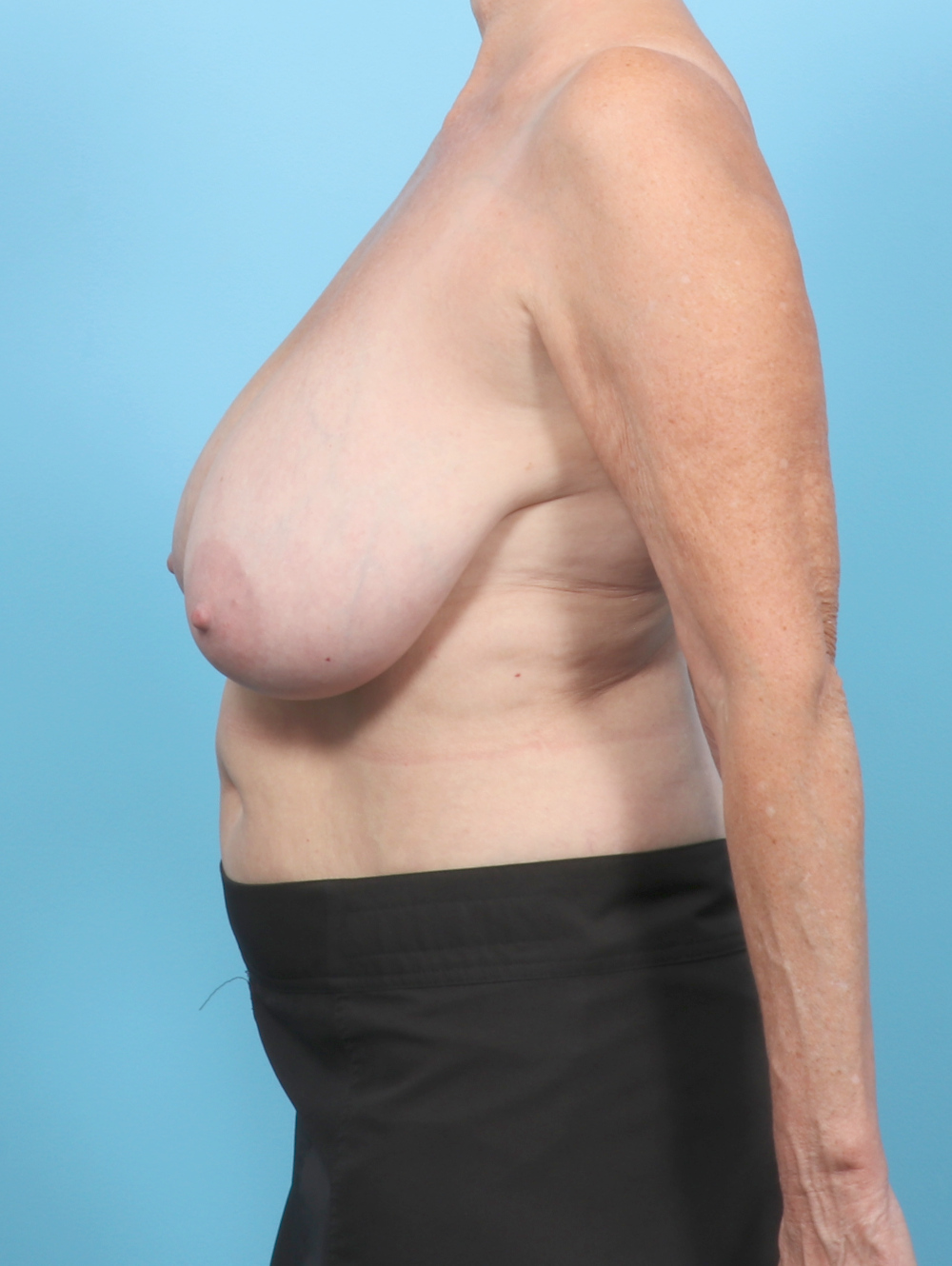 Breast Lift/Reduction Patient Photo - Case 7855 - before view-2