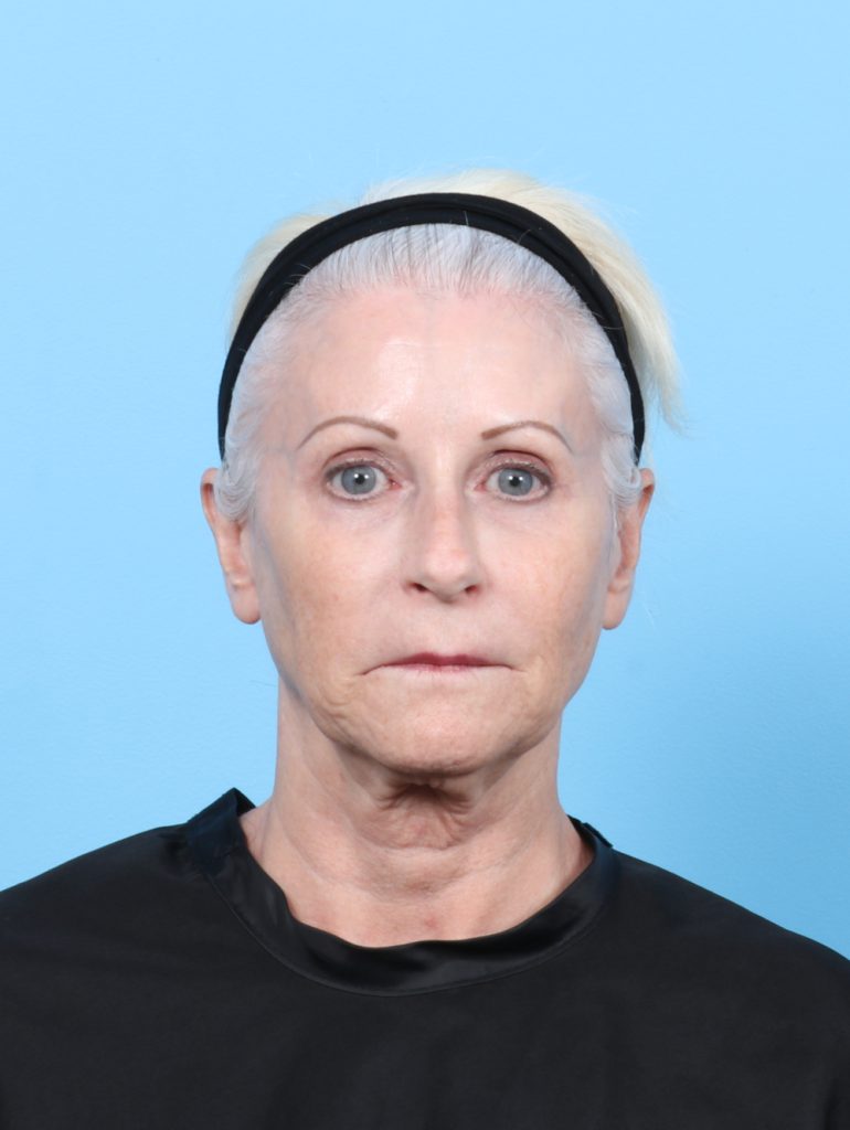 Facelift - Case 7863 - Before