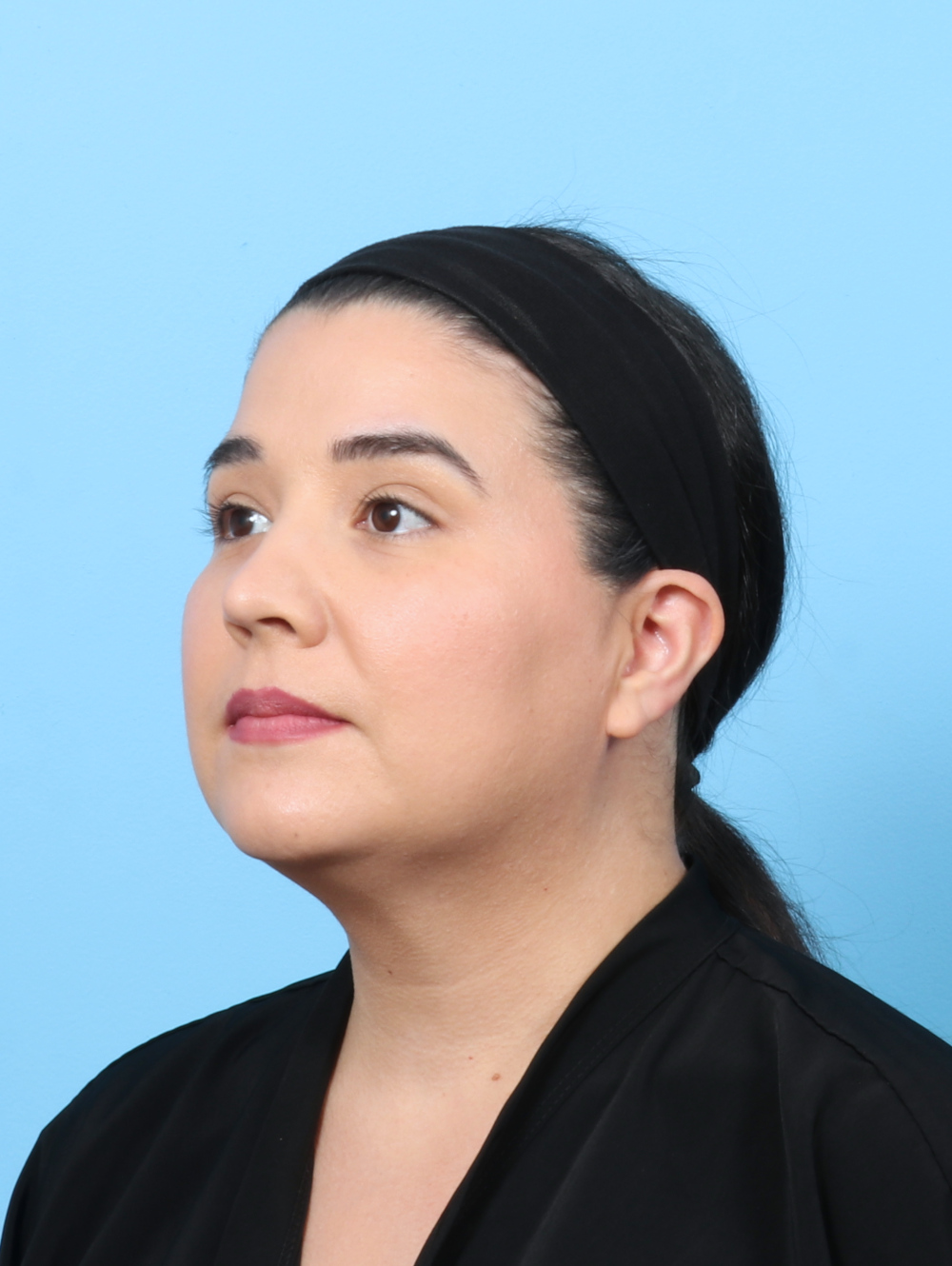 Facial Liposuction Patient Photo - Case 7897 - after view-1