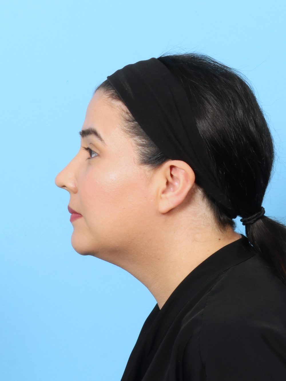 Facial Liposuction Patient Photo - Case 7897 - after view-2