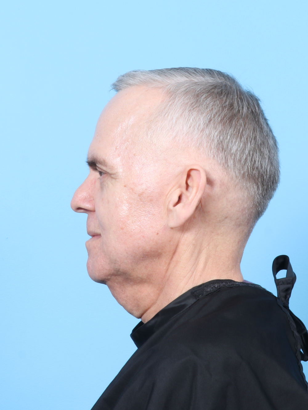 Eyelid Surgery Patient Photo - Case 7915 - after view-2