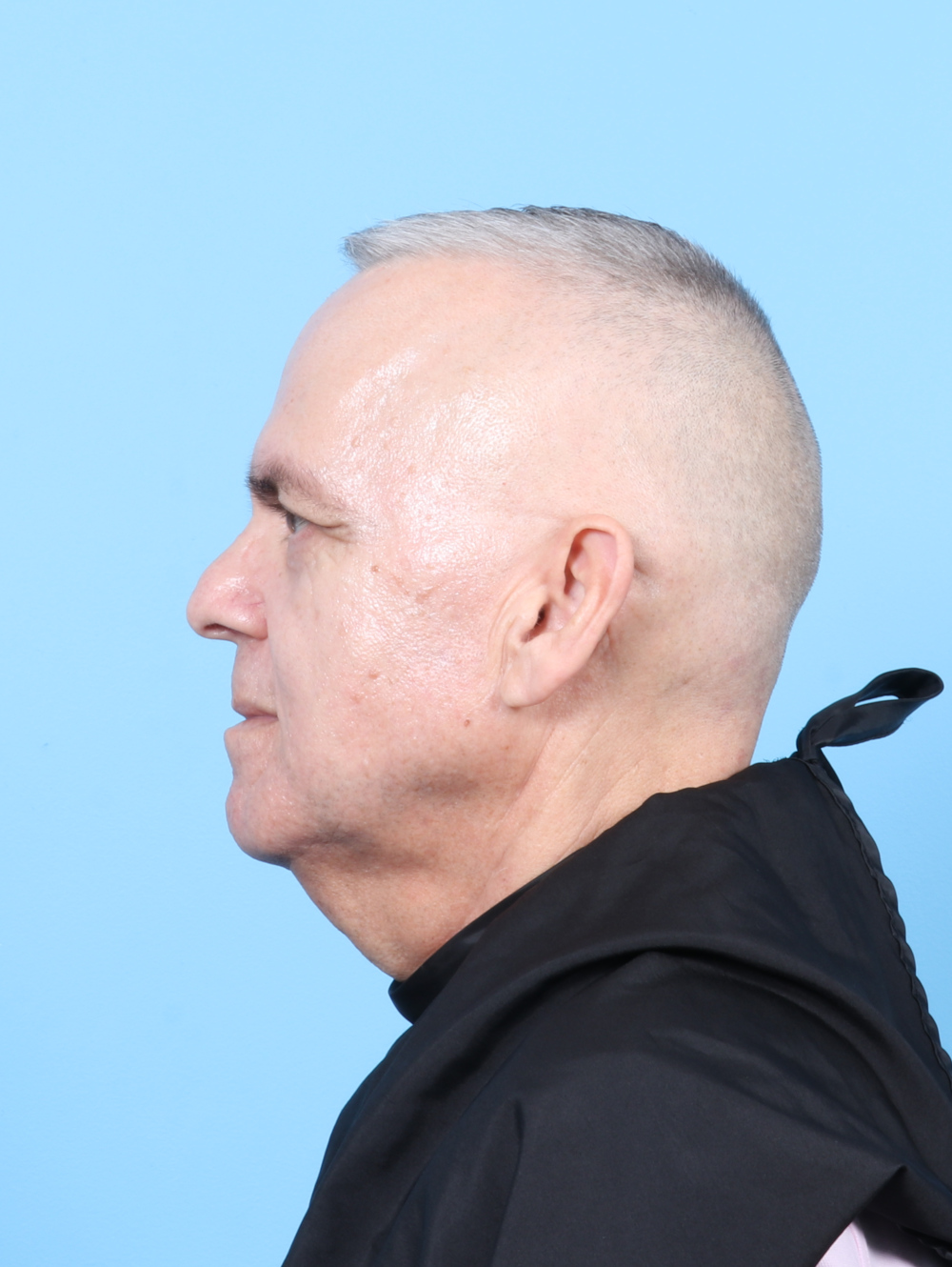 Eyelid Surgery Patient Photo - Case 7915 - before view-2