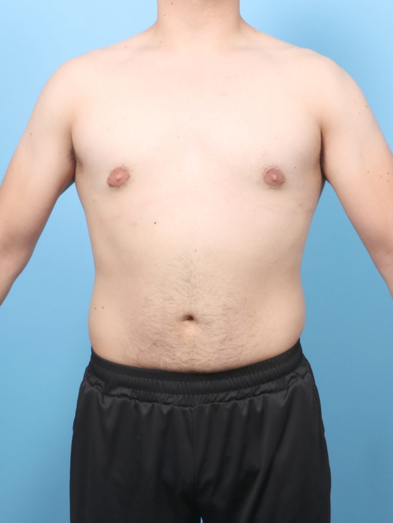 Male Breast Reduction - Case 7998 - After