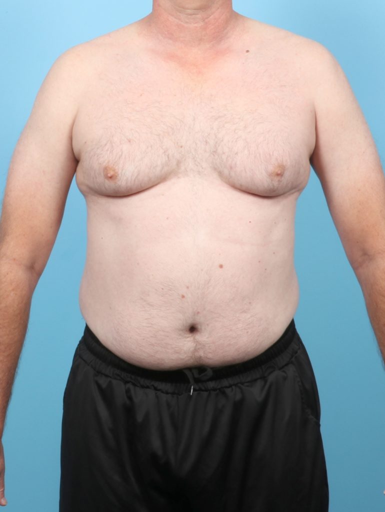 Male Breast Reduction - Case 8006 - Before