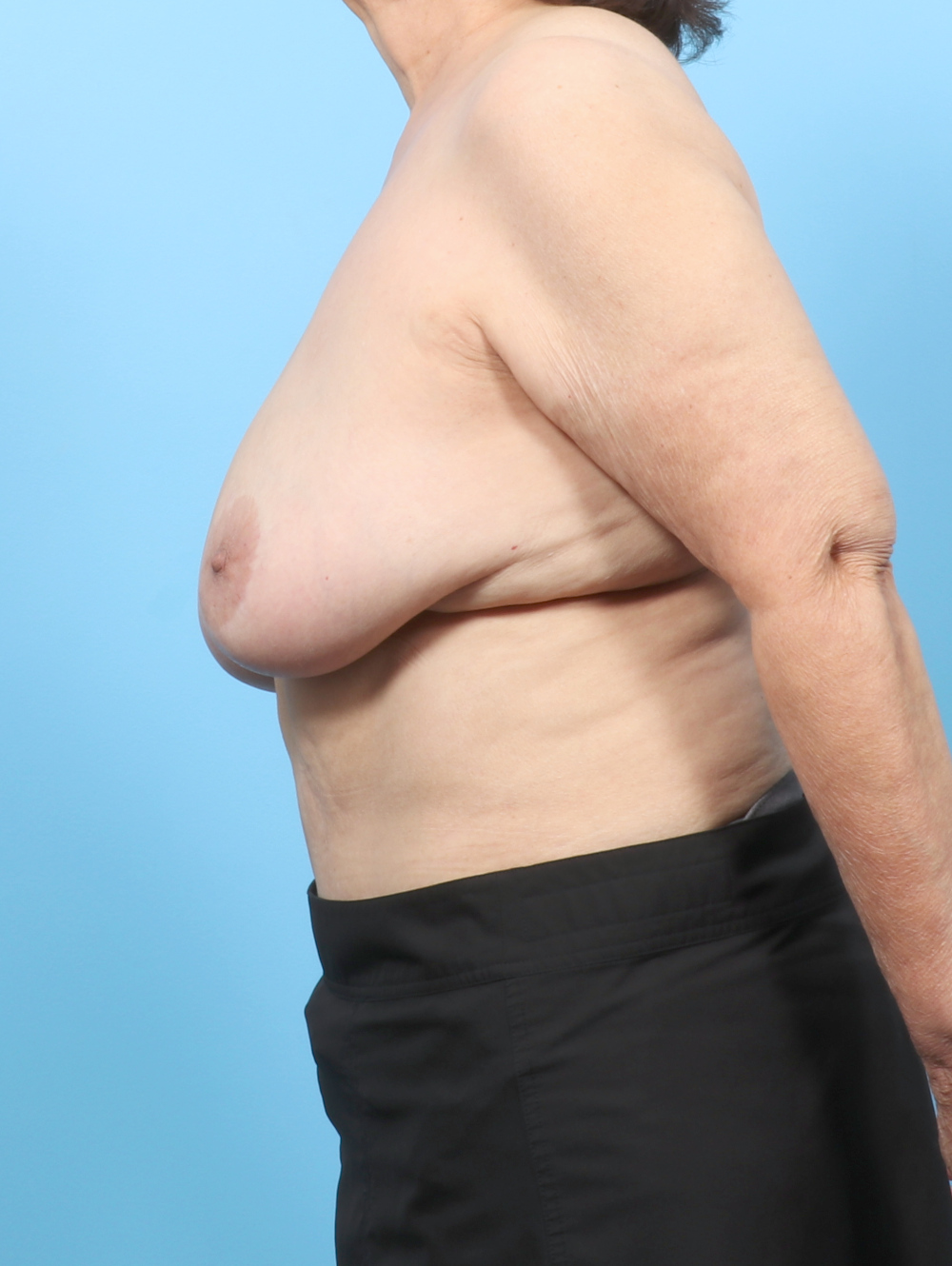 Breast Lift/Reduction Patient Photo - Case 8145 - before view-2