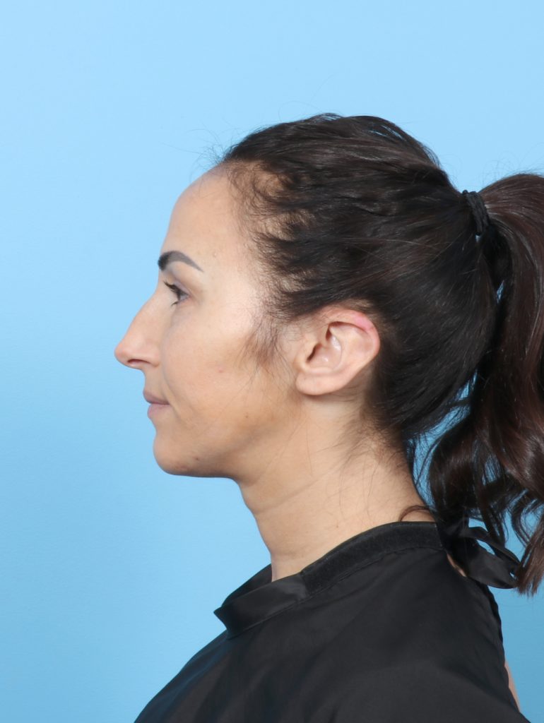 Rhinoplasty - Case 8153 - Before