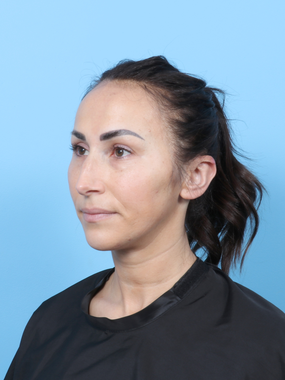 Rhinoplasty Patient Photo - Case 8153 - before view-2