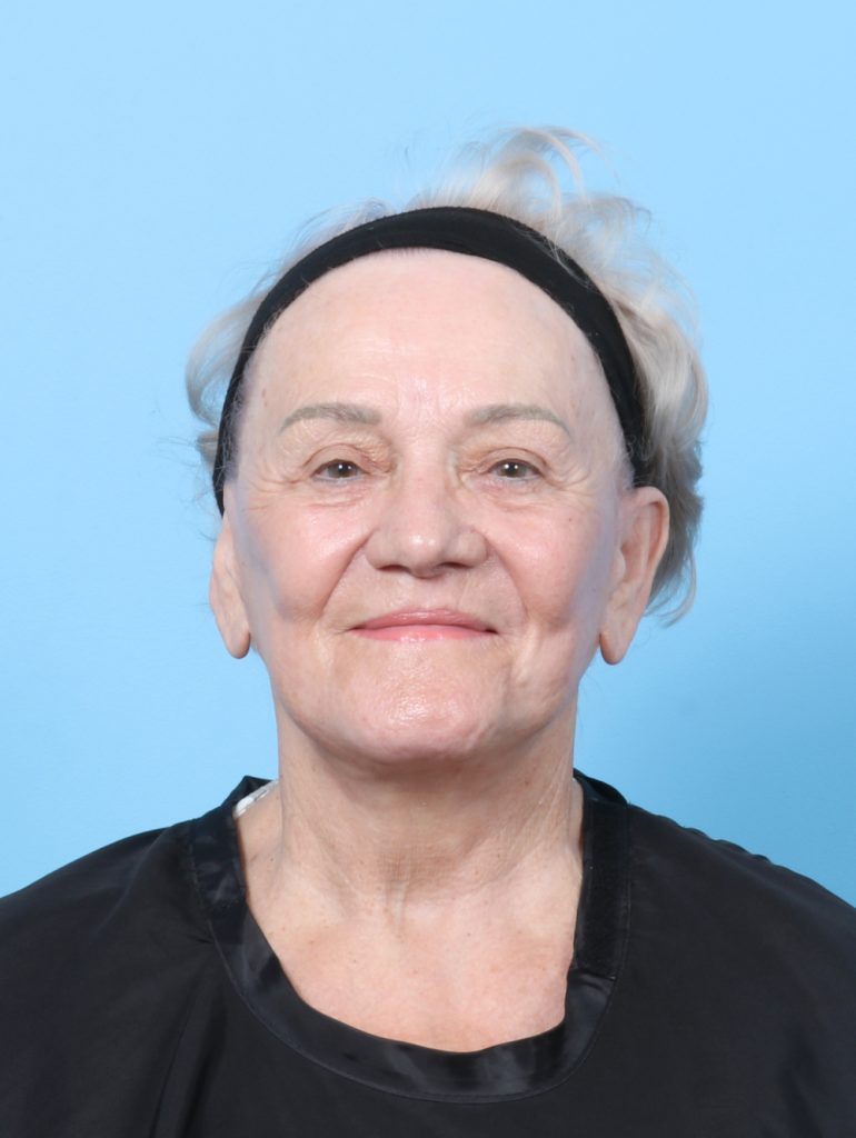 Facelift - Case 8177 - After