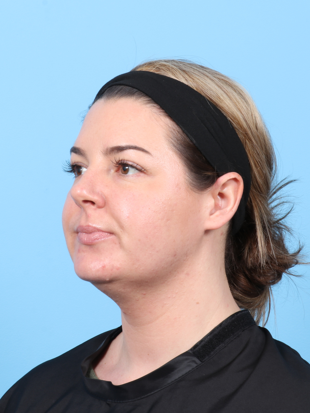 Facial Liposuction Patient Photo - Case 8195 - before view-1