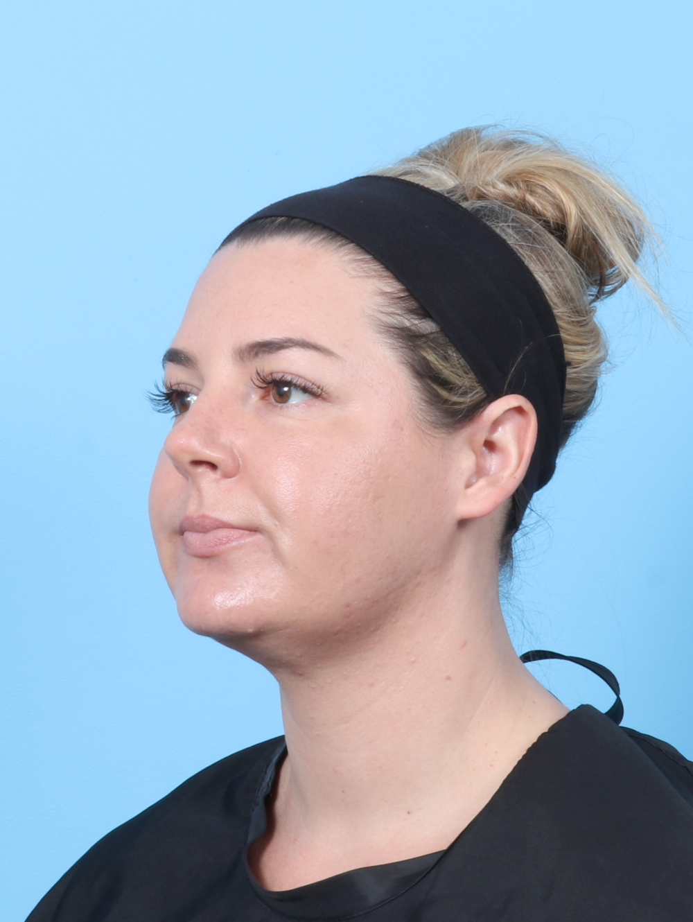 Facial Liposuction Patient Photo - Case 8195 - after view-1