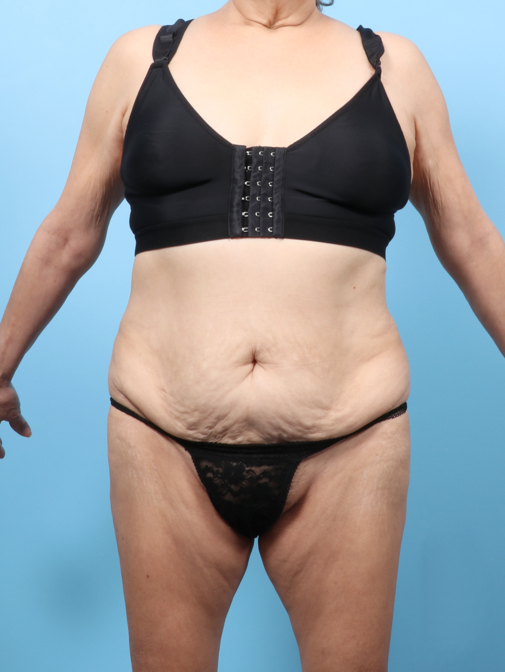Body Lift Patient Photo - Case 8245 - before view-