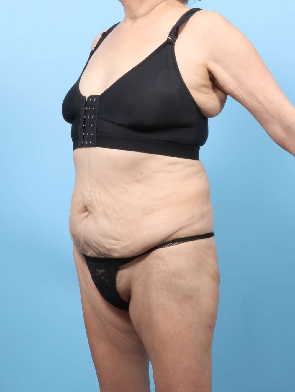 Body Lift Patient Photo - Case 8245 - before view-2