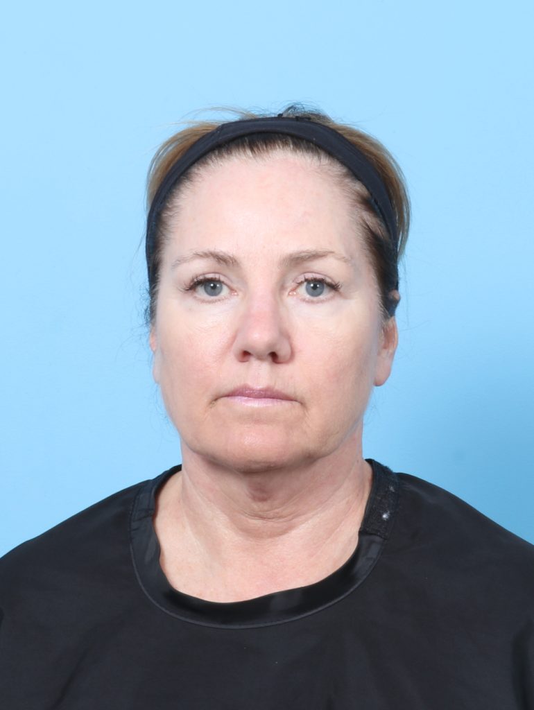 Eyelid Surgery - Case 8298 - After