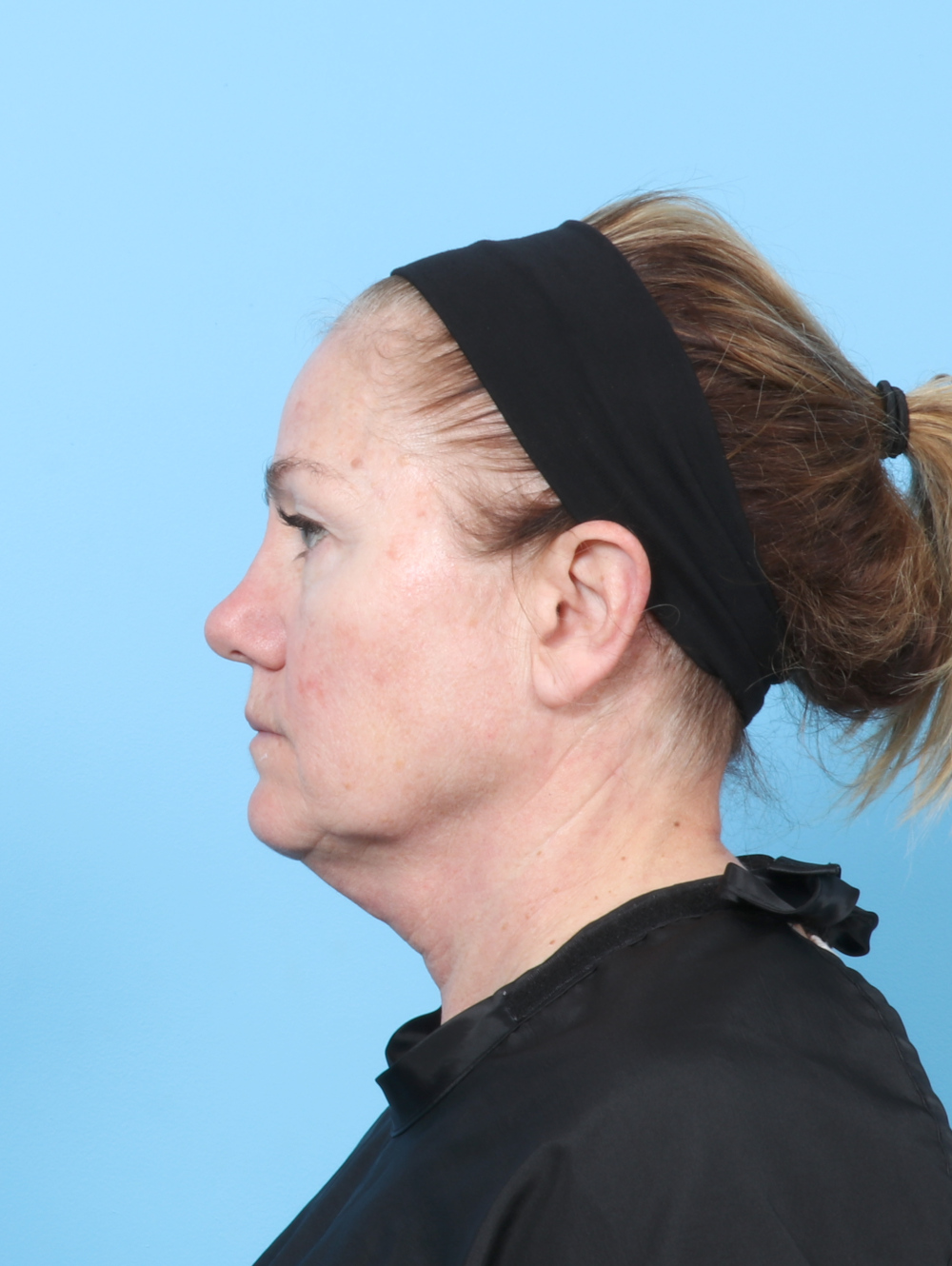 Eyelid Surgery Patient Photo - Case 8298 - before view-2