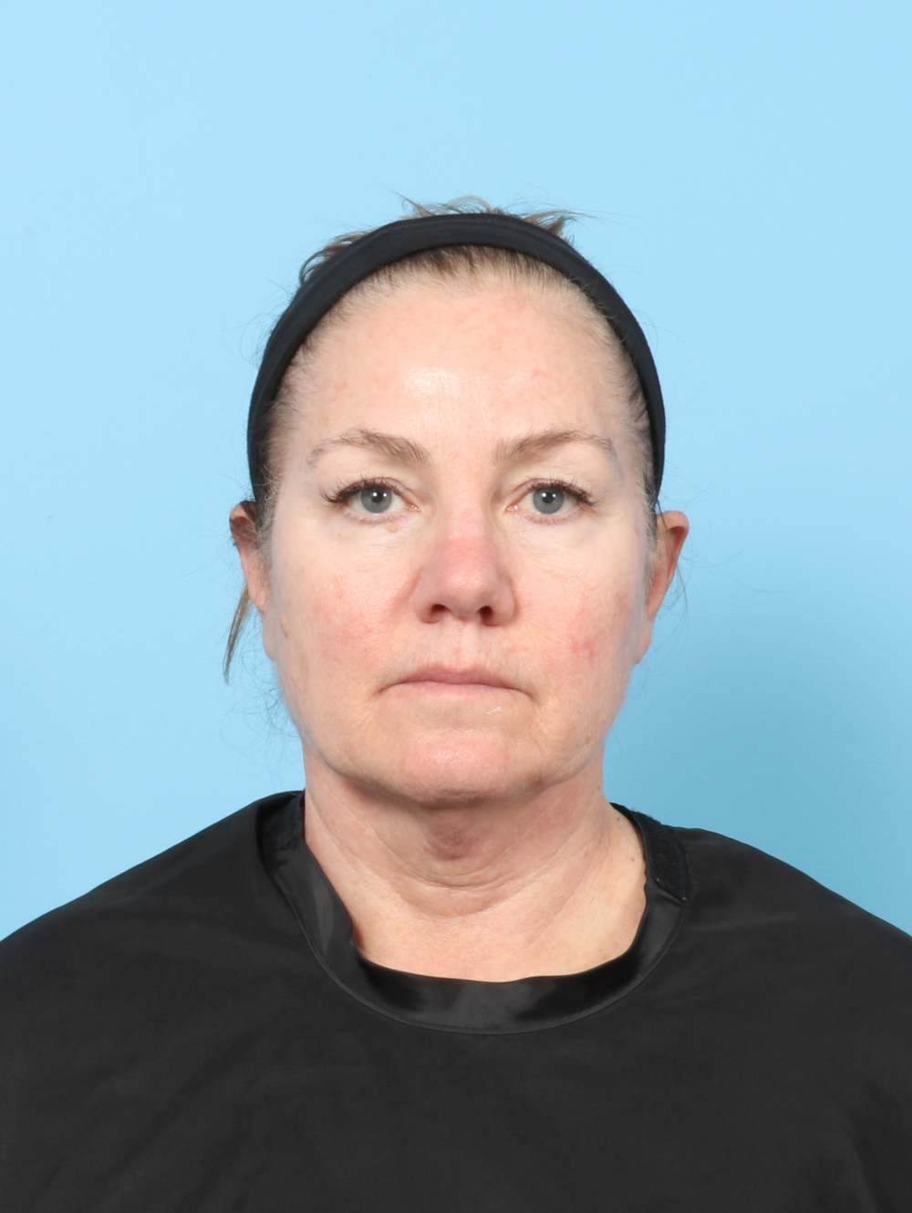 Eyelid Surgery Patient Photo - Case 8298 - before view-