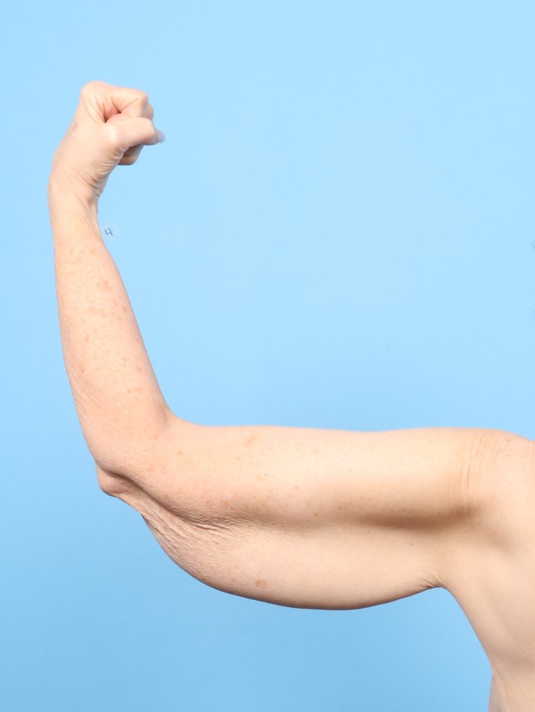 Arm Lift - Case 8324 - Before