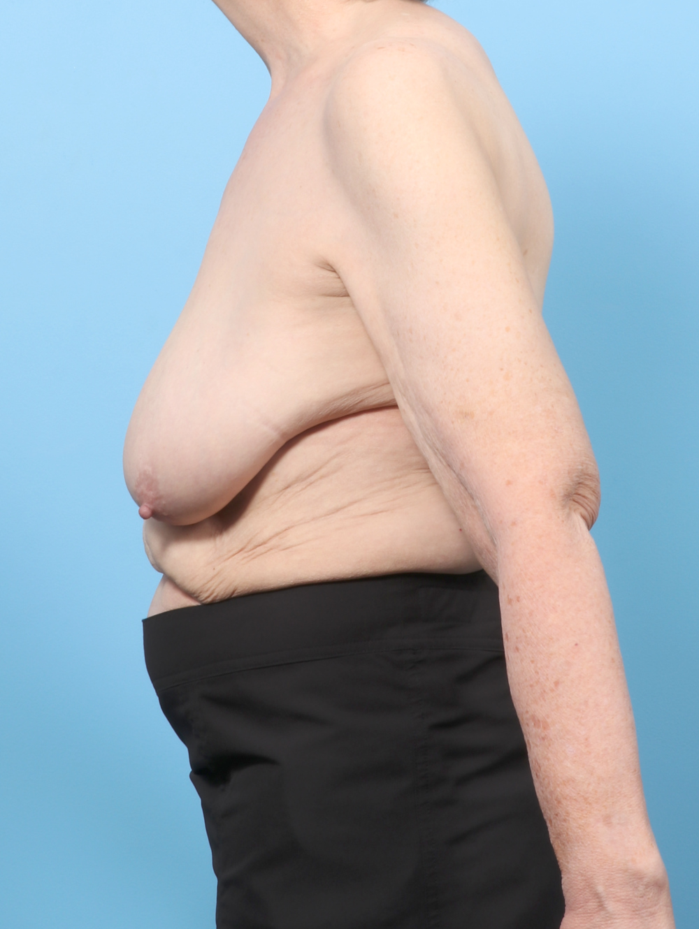 Breast Lift/Reduction Patient Photo - Case 8330 - before view-2