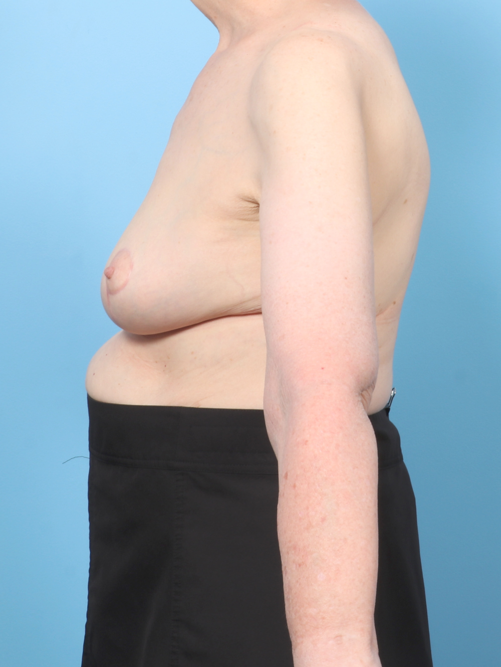 Breast Lift/Reduction Patient Photo - Case 8330 - after view-2