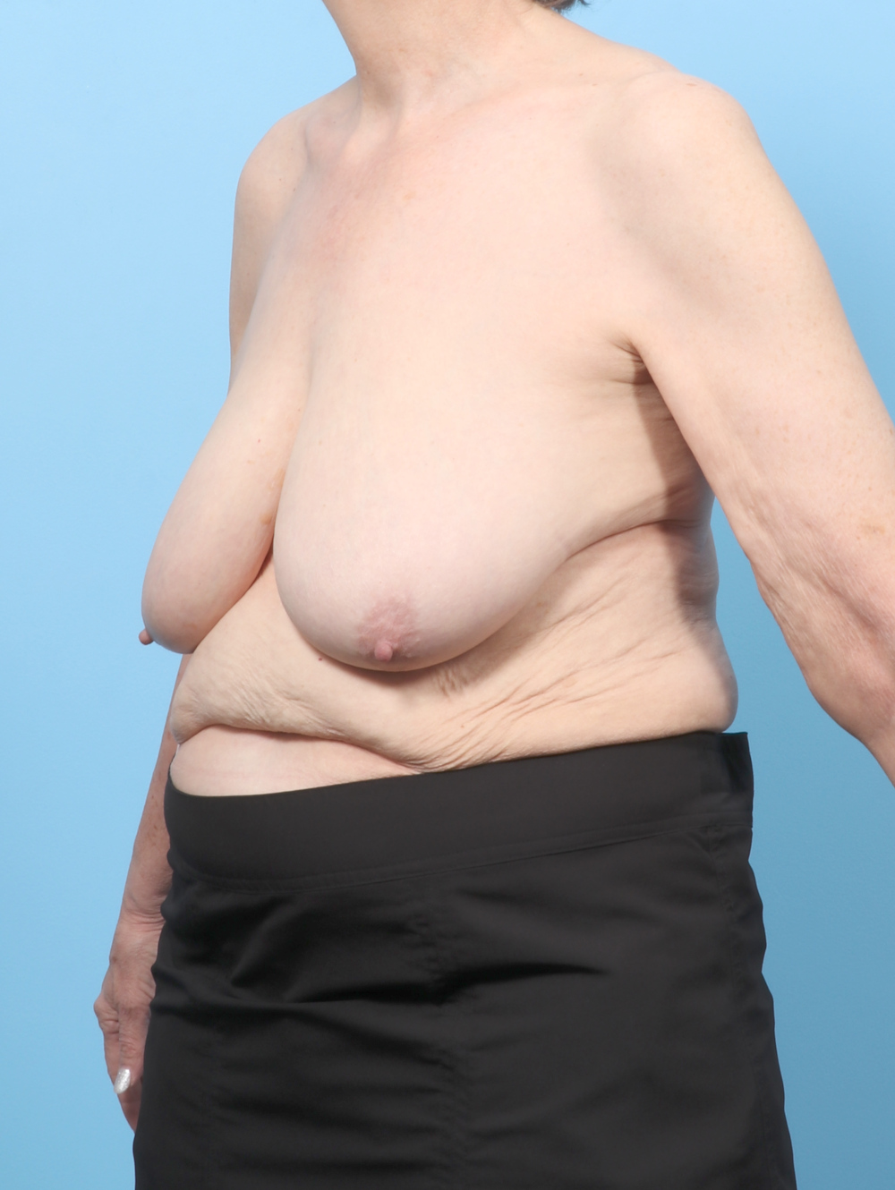 Breast Lift/Reduction Patient Photo - Case 8330 - before view-1