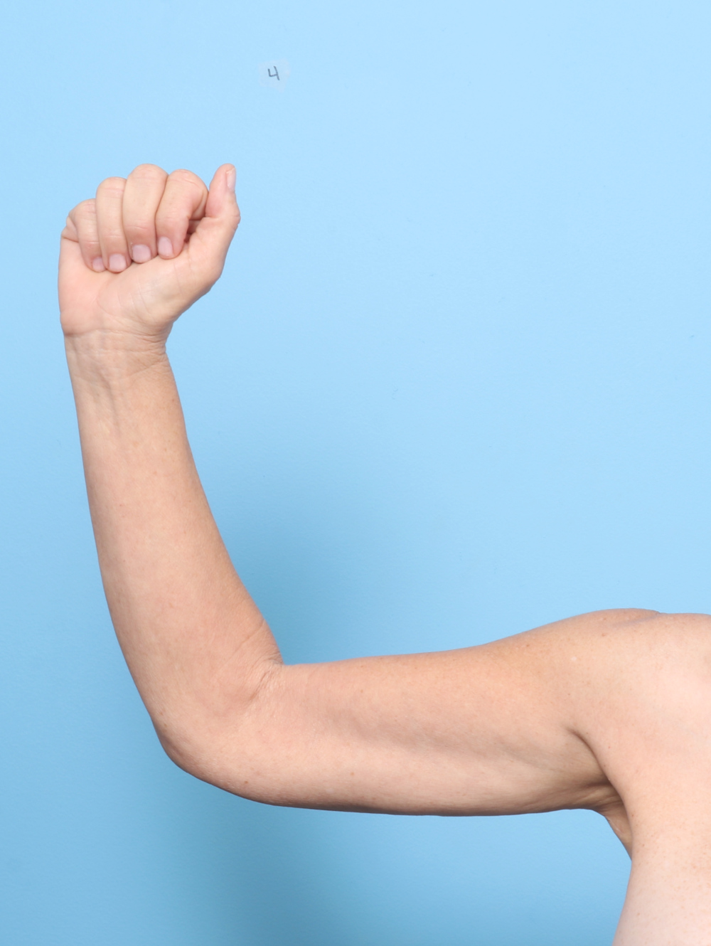 Arm Lift Patient Photo - Case 8346 - after view-1