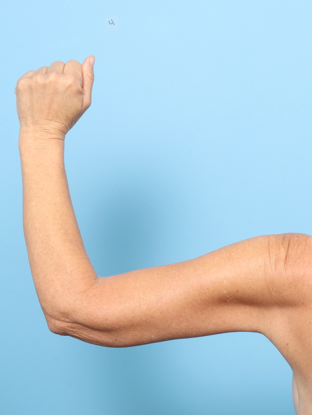 Arm Lift Patient Photo - Case 8346 - after view