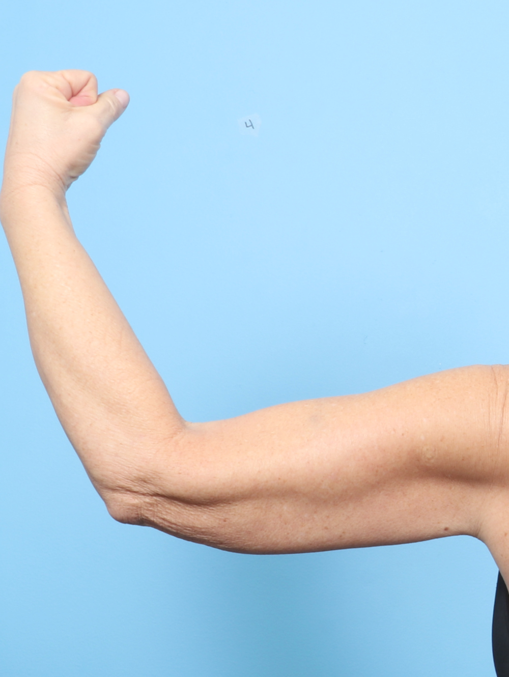 Arm Lift Patient Photo - Case 8346 - before view-