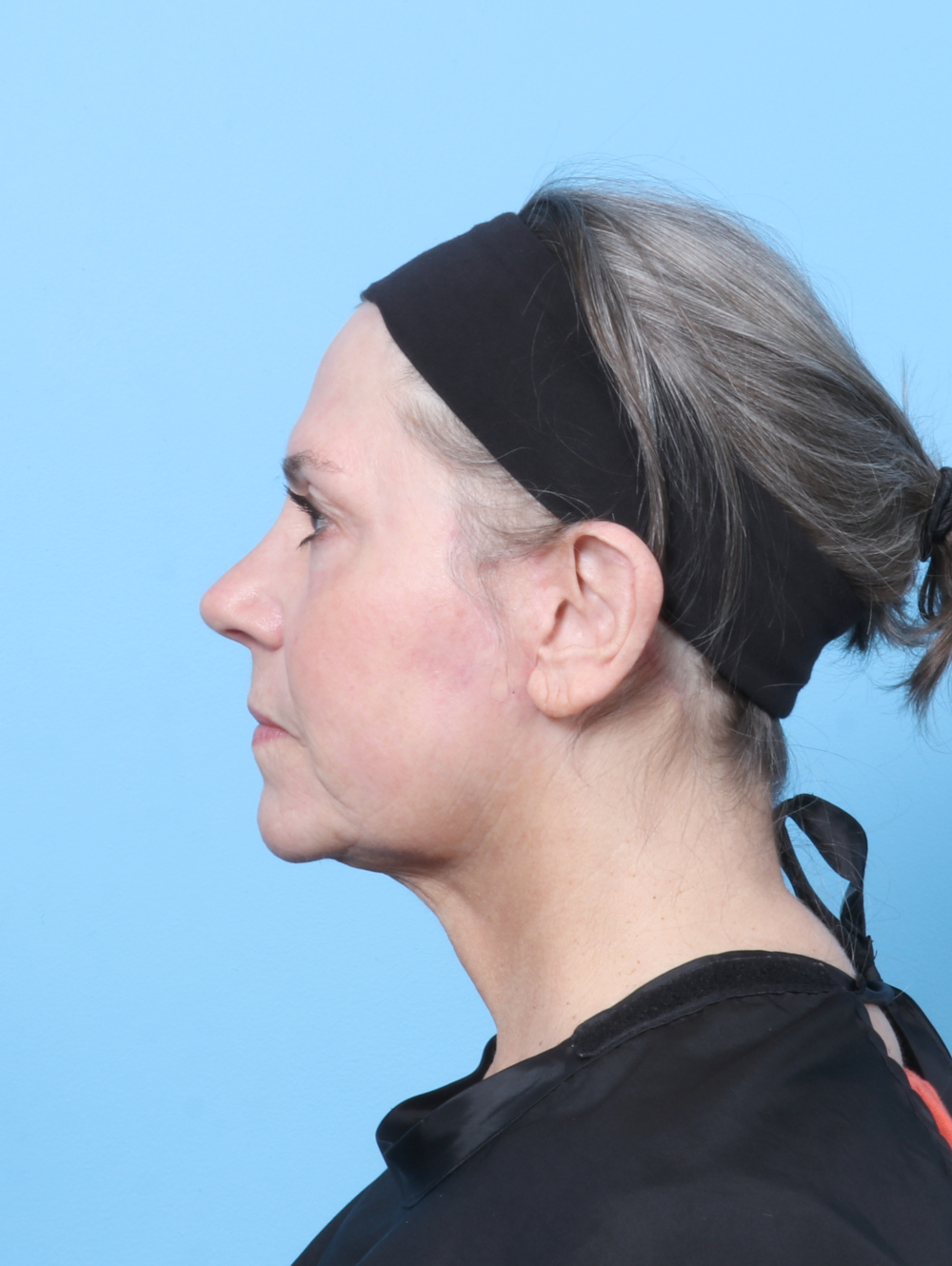Facelift Patient Photo - Case 8394 - after view-2