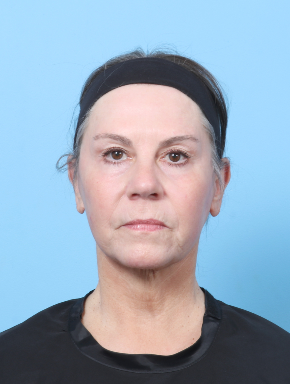 Facelift Patient Photo - Case 8394 - after view