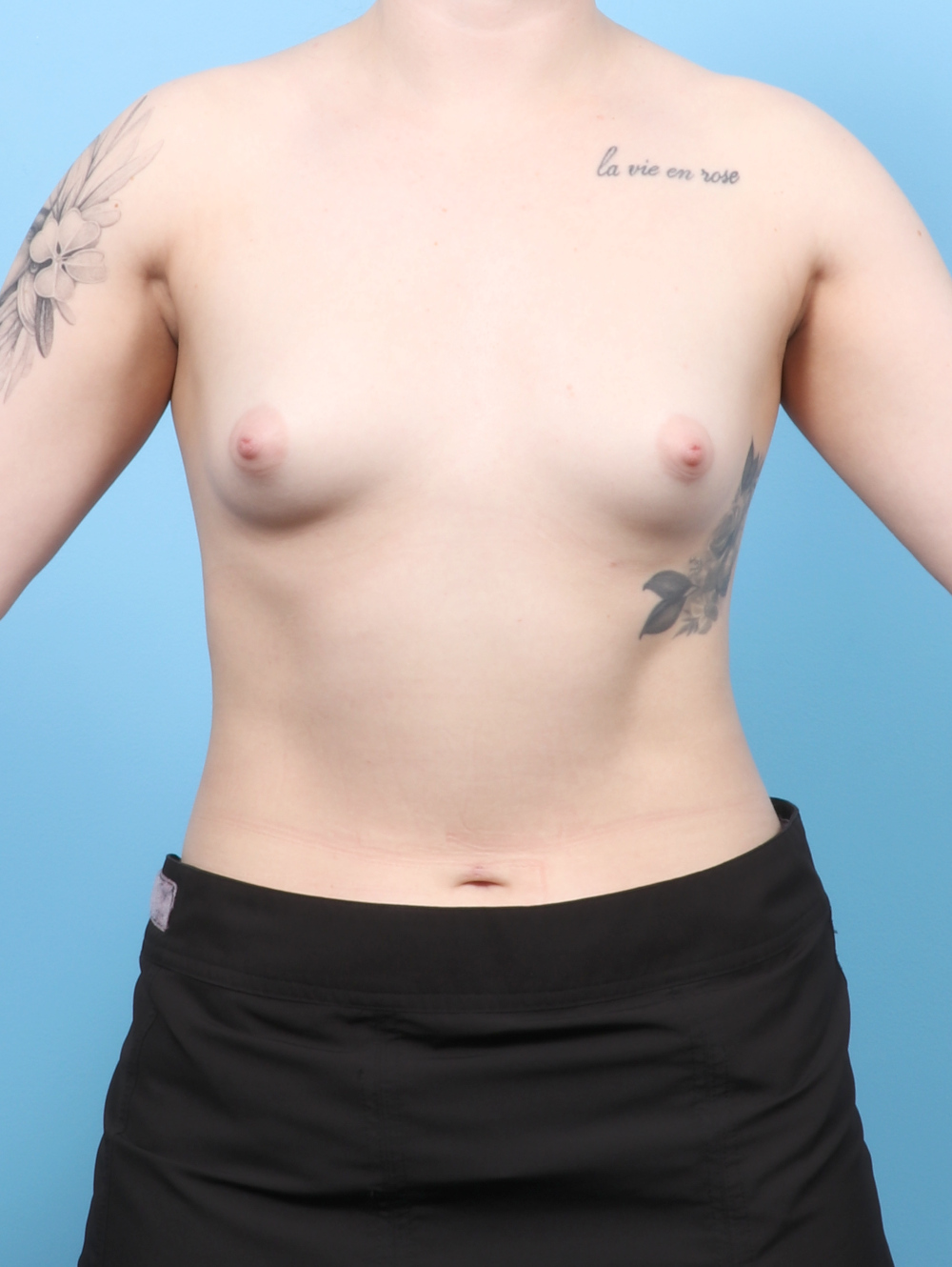 Breast Augmentation Patient Photo - Case 8409 - before view-