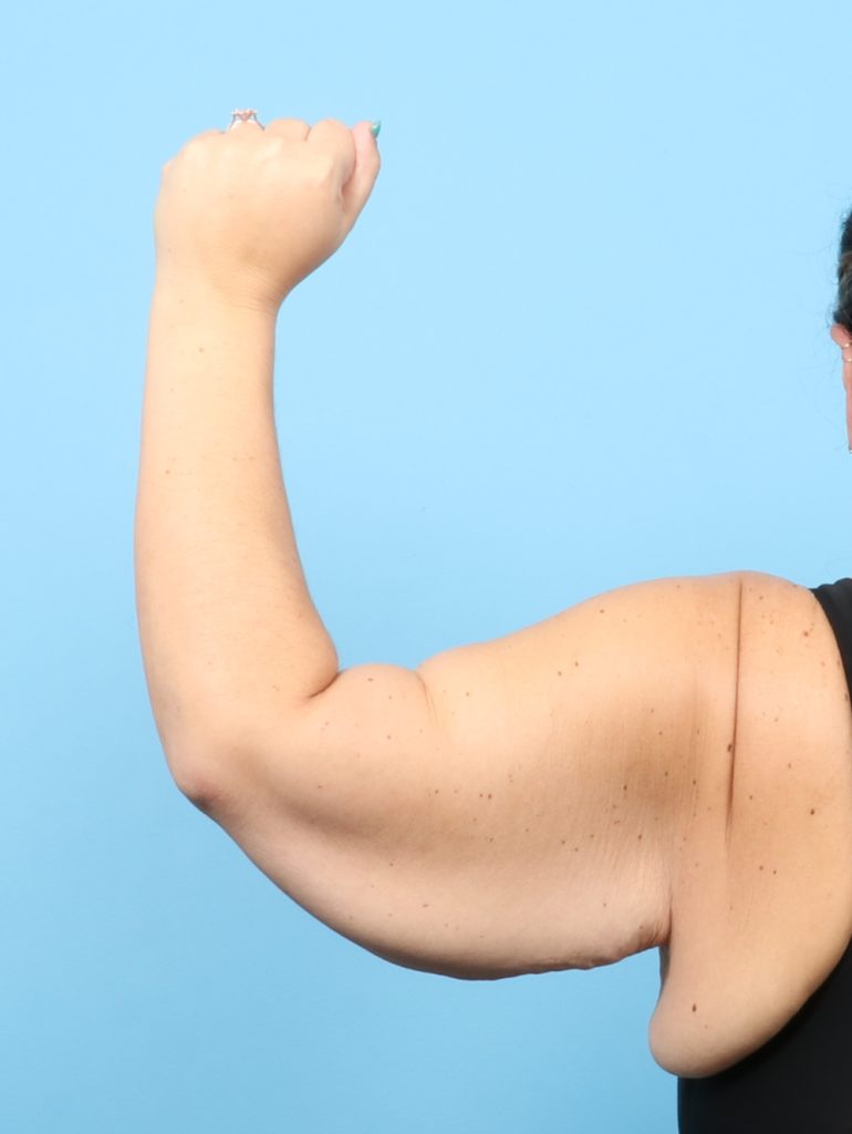 Arm Lift - Case 8417 - Before