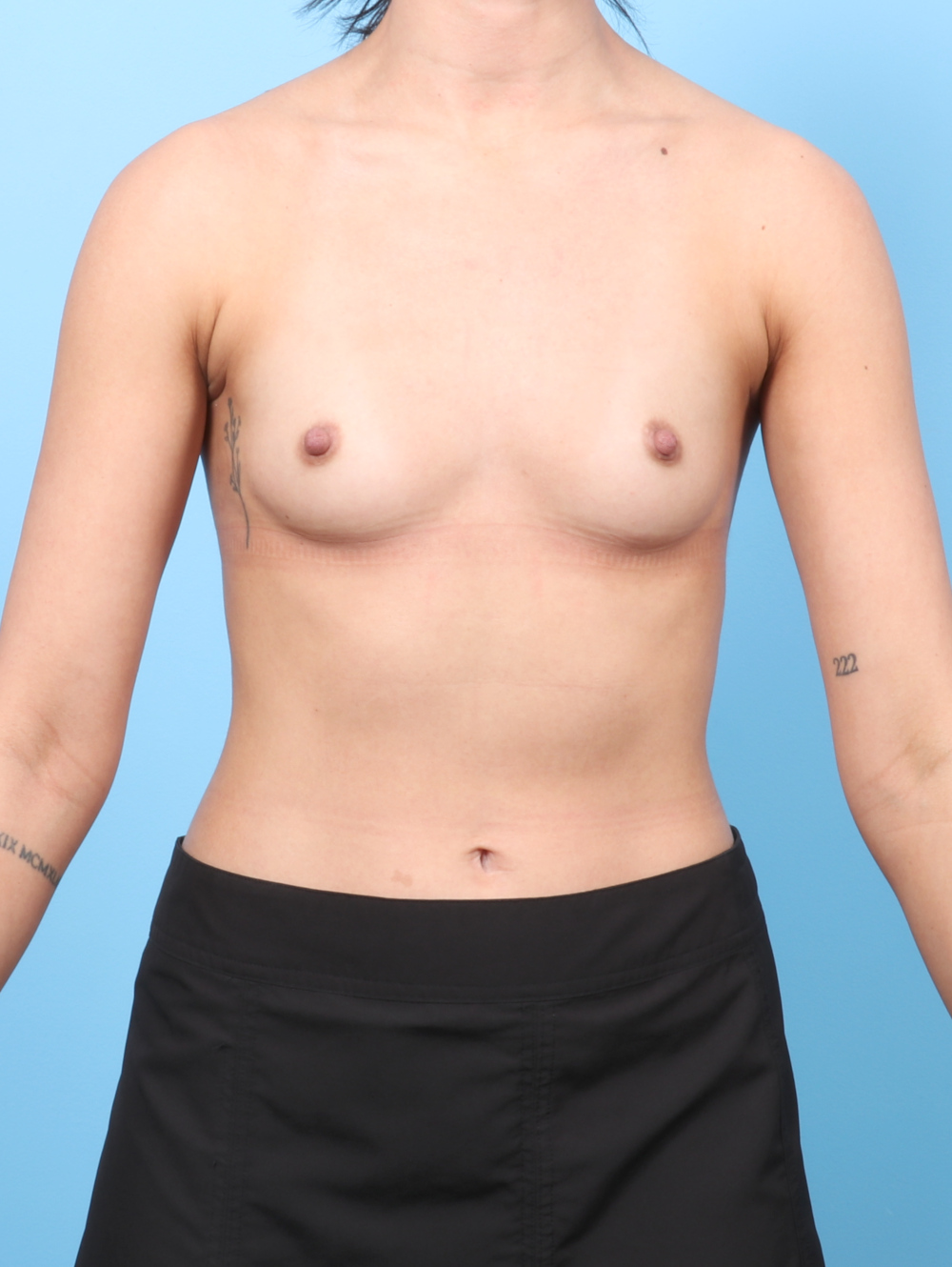 Breast Augmentation Patient Photo - Case 8447 - before view-