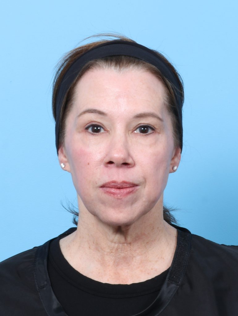 Eyelid Surgery - Case 8463 - After