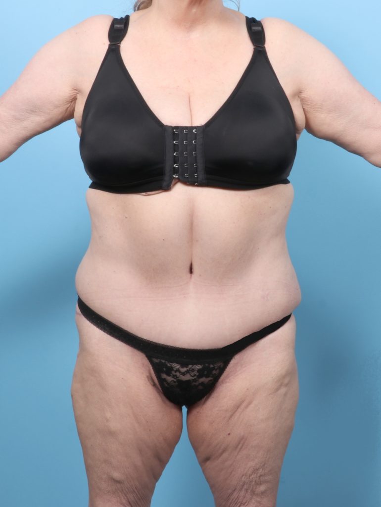 Tummy Tuck - Case 8511 - After