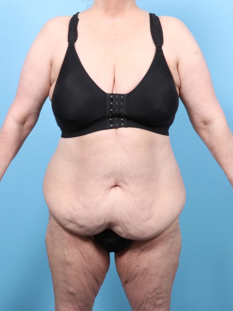 Tummy Tuck - Case 8511 - Before