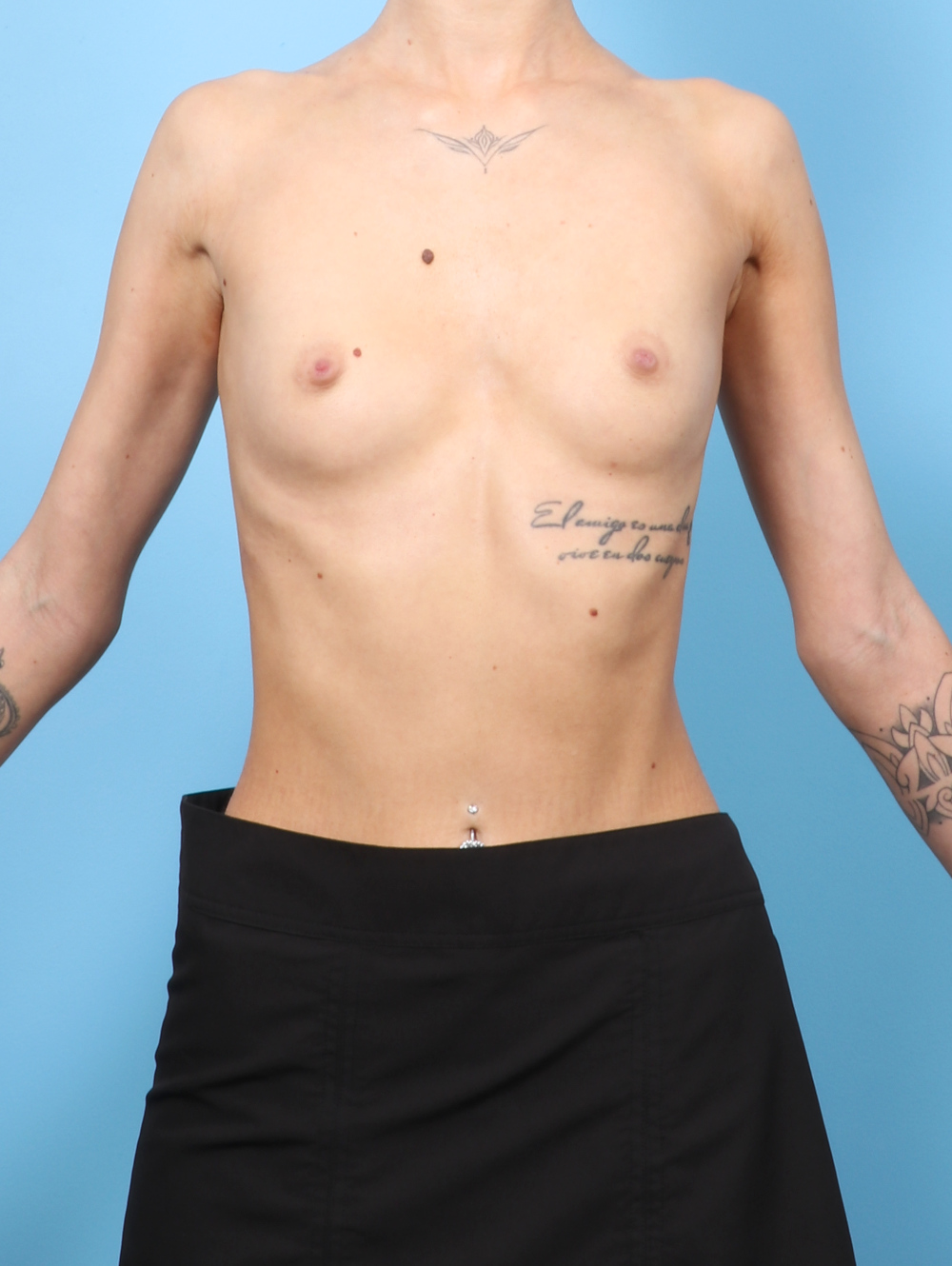 Breast Augmentation Patient Photo - Case 8570 - before view-