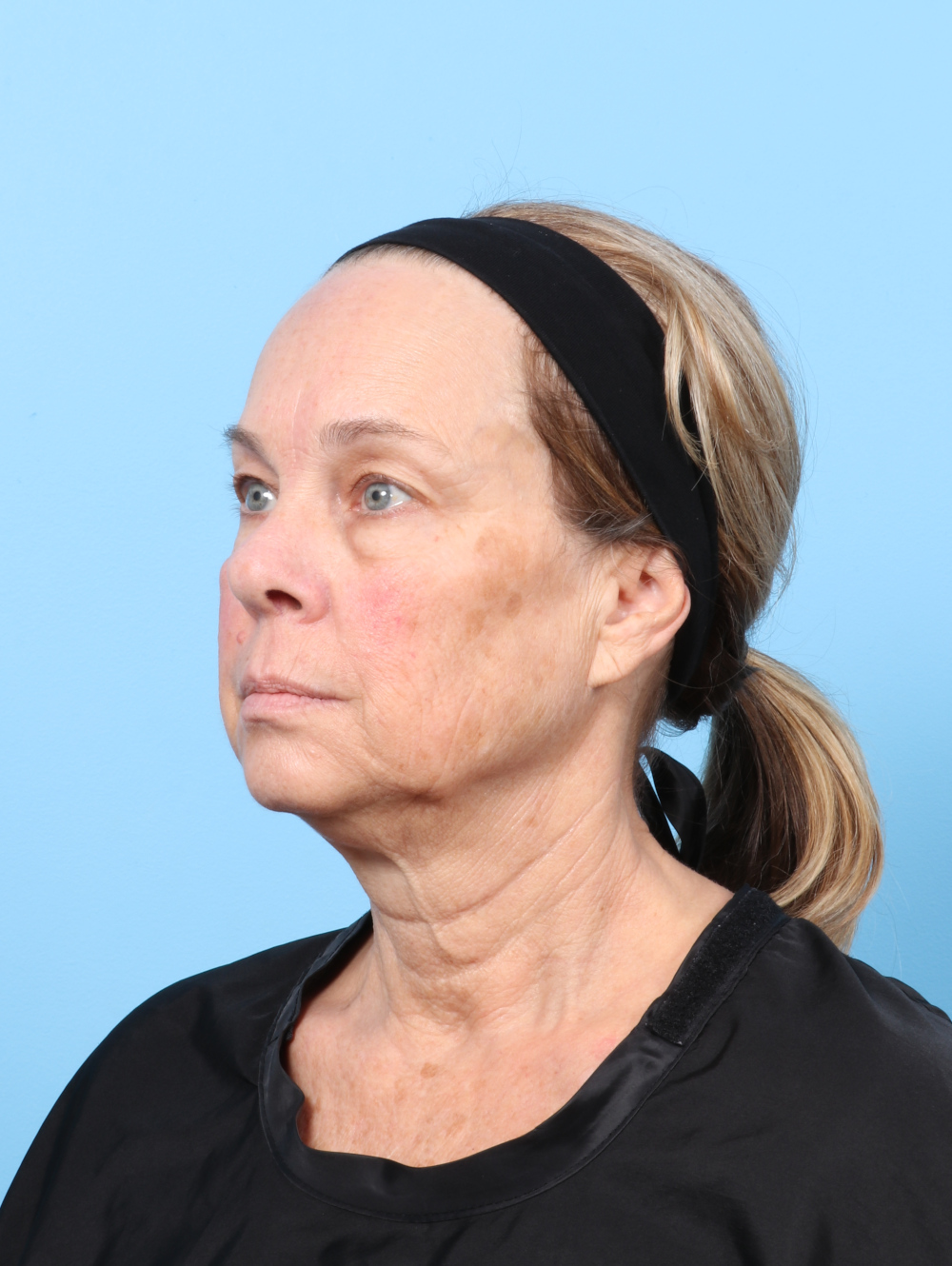 Eyelid Surgery Patient Photo - Case 8602 - before view-1