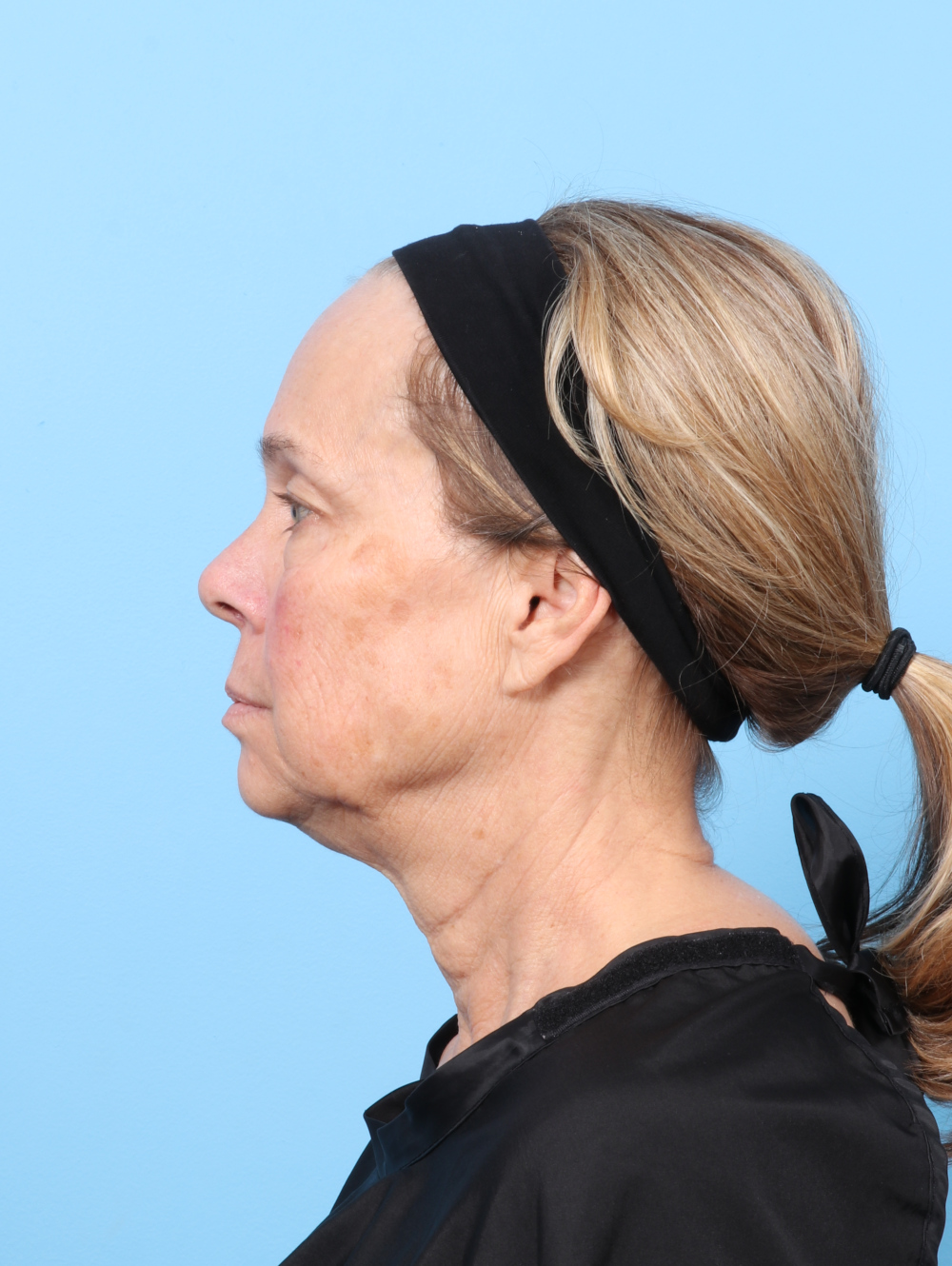 Eyelid Surgery Patient Photo - Case 8602 - before view-2