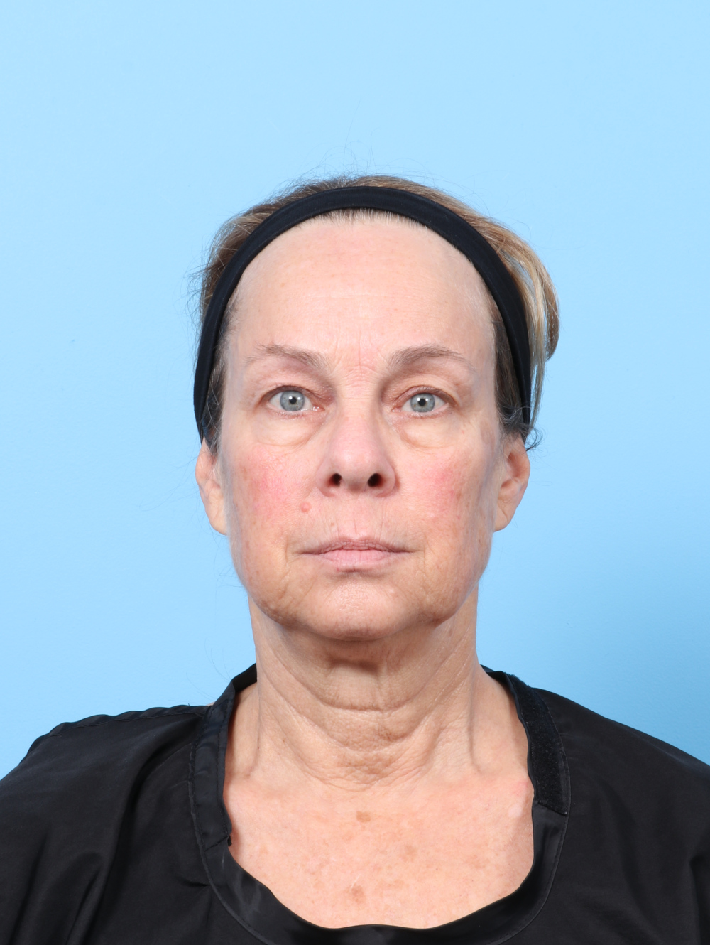 Eyelid Surgery Patient Photo - Case 8602 - before view-
