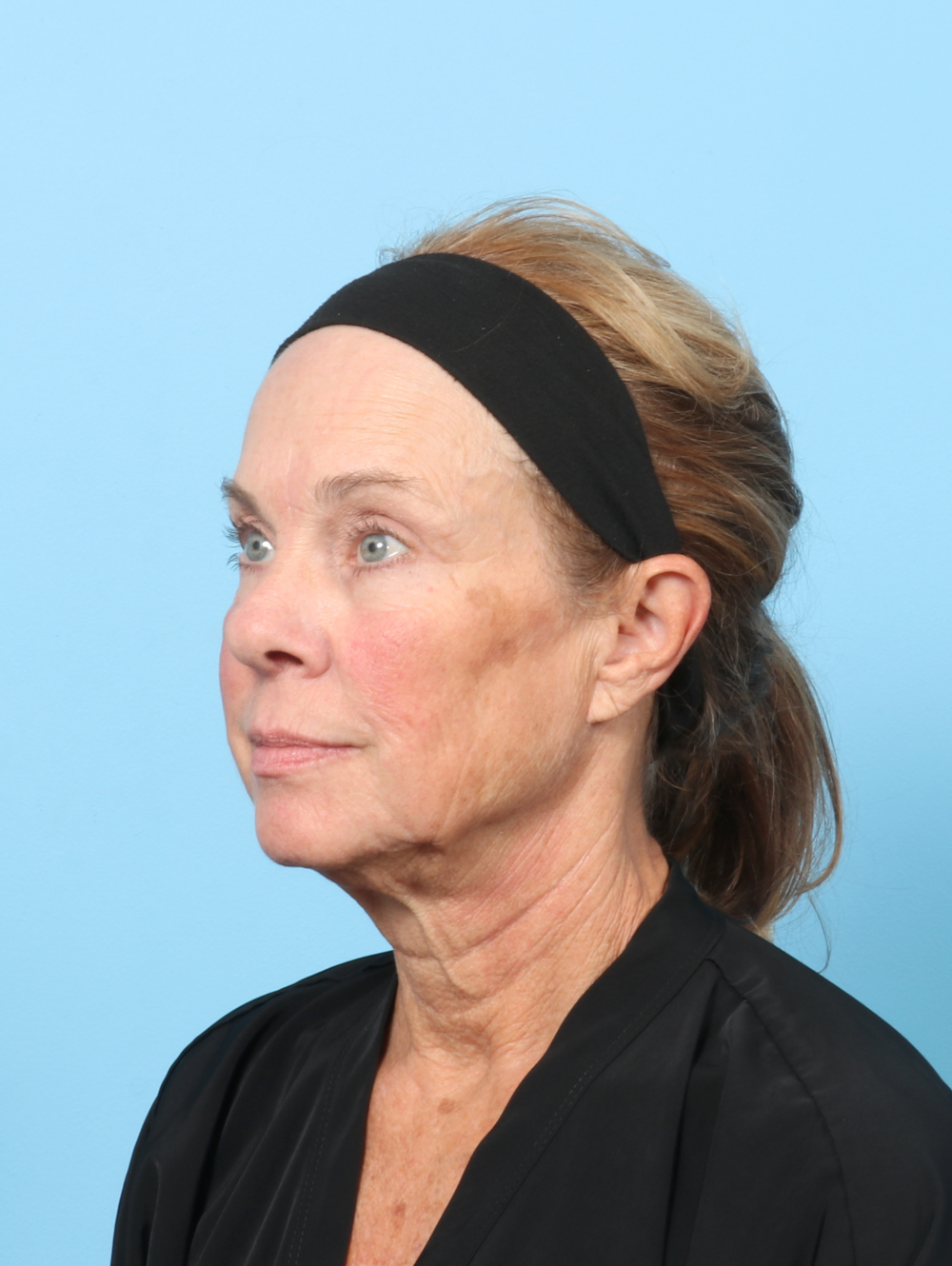 Eyelid Surgery Patient Photo - Case 8602 - after view-1