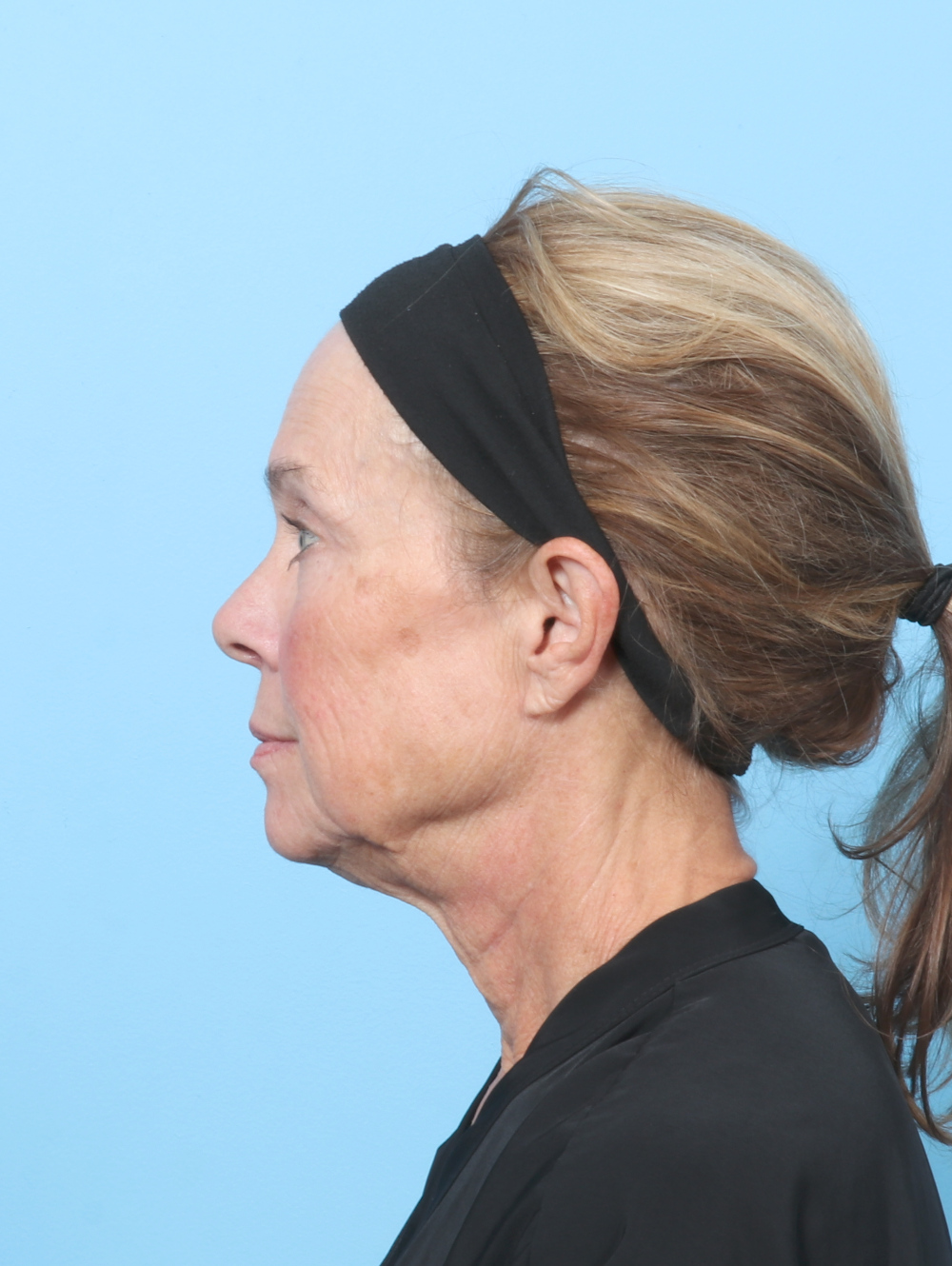 Eyelid Surgery Patient Photo - Case 8602 - after view-2