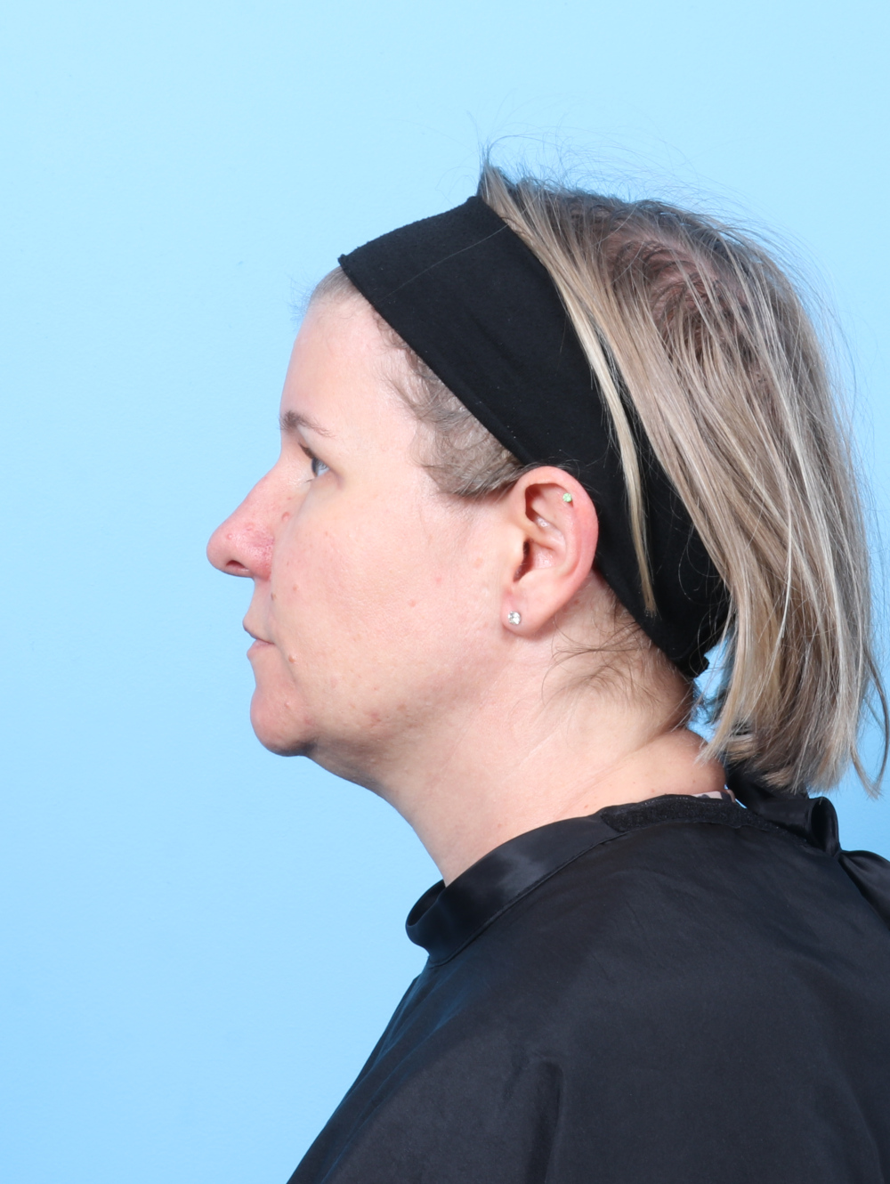 Eyelid Surgery Patient Photo - Case 8610 - after view-2