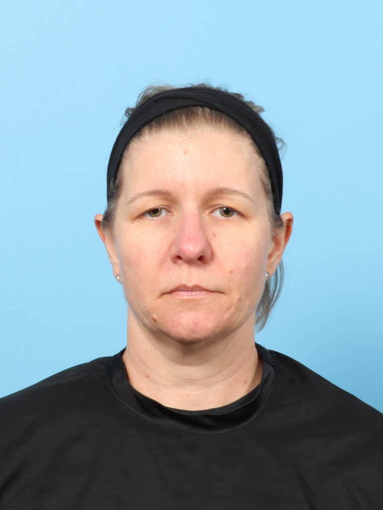 Eyelid Surgery - Case 8610 - Before