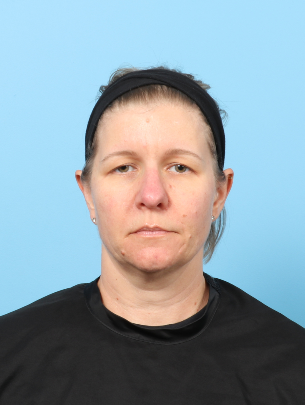 Eyelid Surgery Patient Photo - Case 8610 - before view-