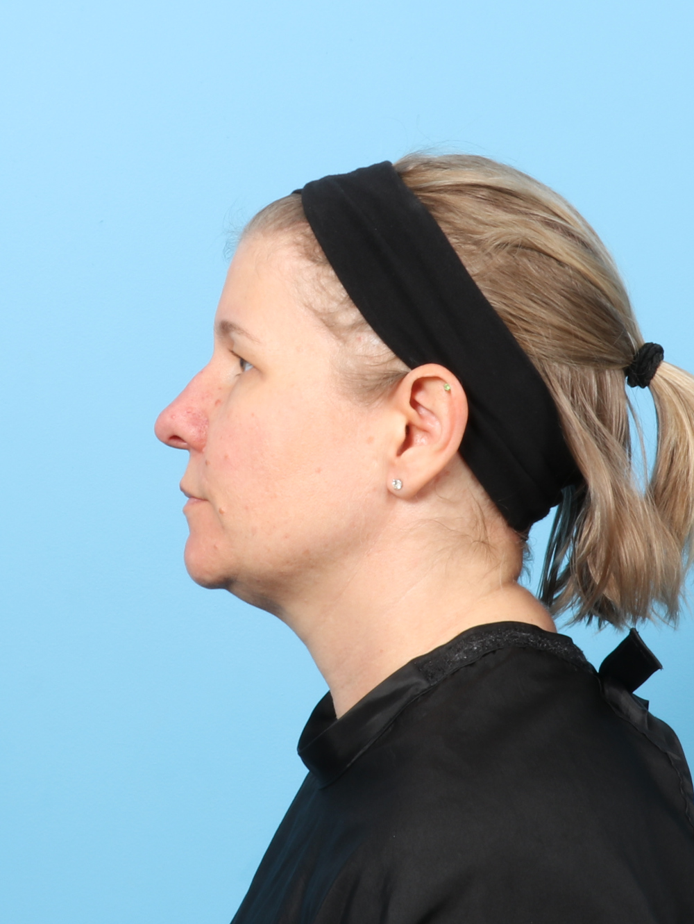 Eyelid Surgery Patient Photo - Case 8610 - before view-2