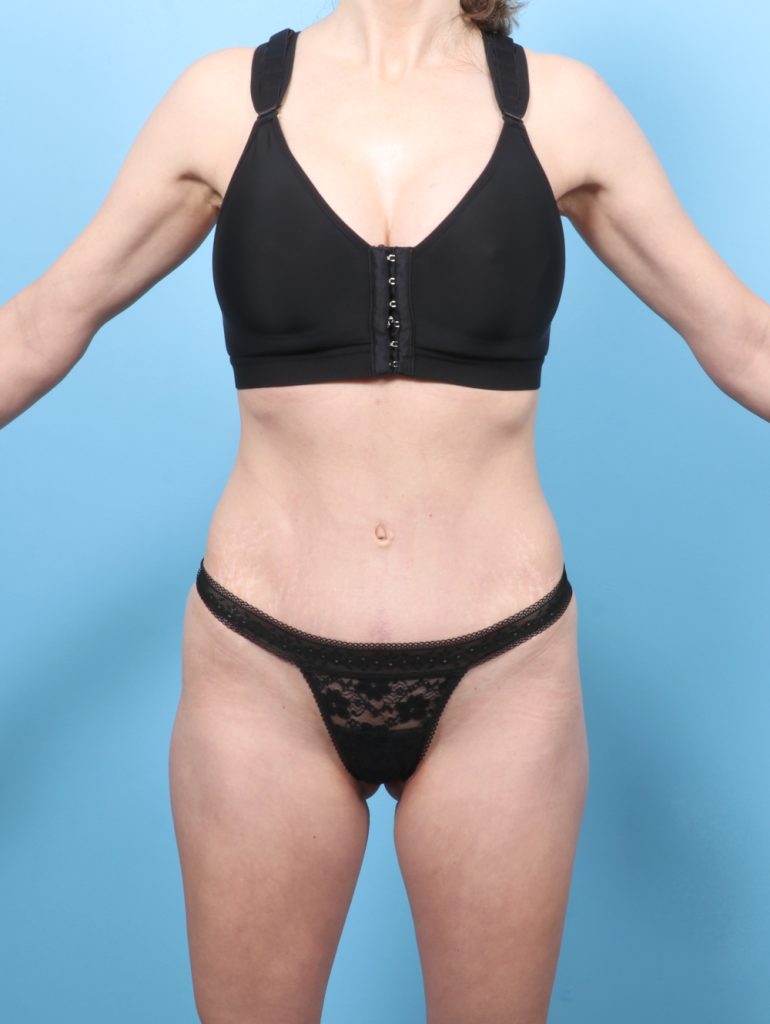 Tummy Tuck - Case 8650 - After