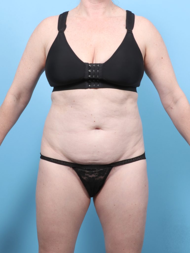 Tummy Tuck - Case 8674 - Before