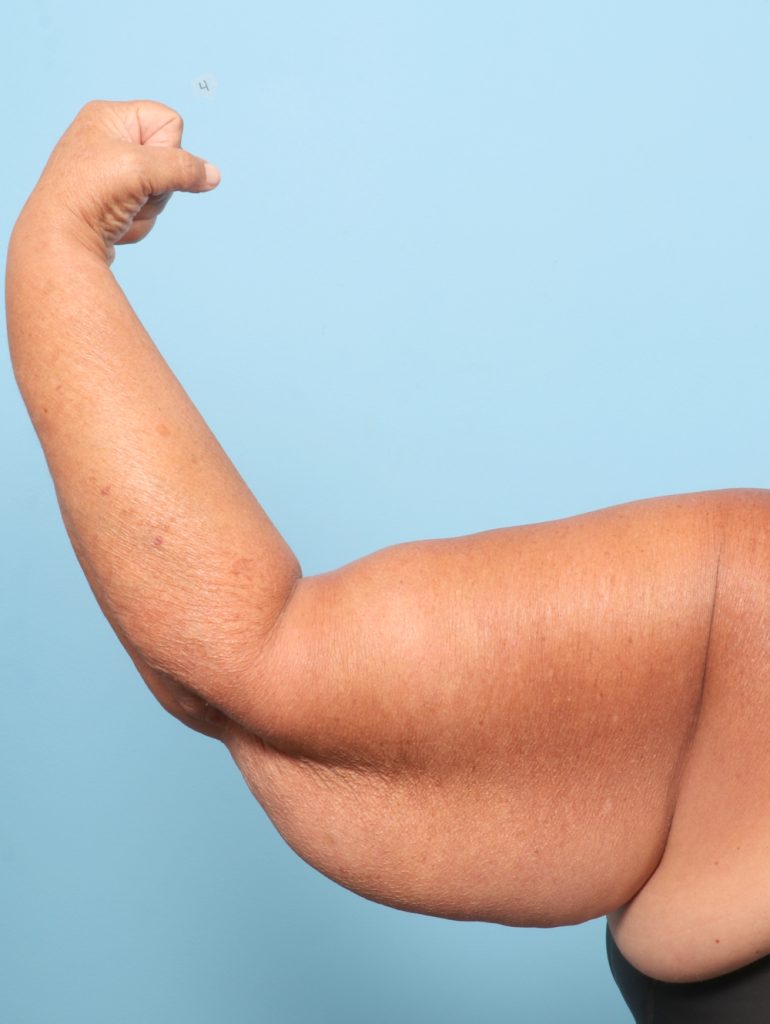 Arm Lift - Case 8724 - Before